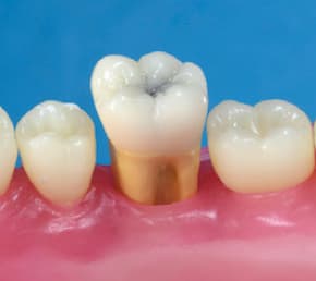 Radiopaque Endodontic Training Tooth, 46/LR6, First Molar